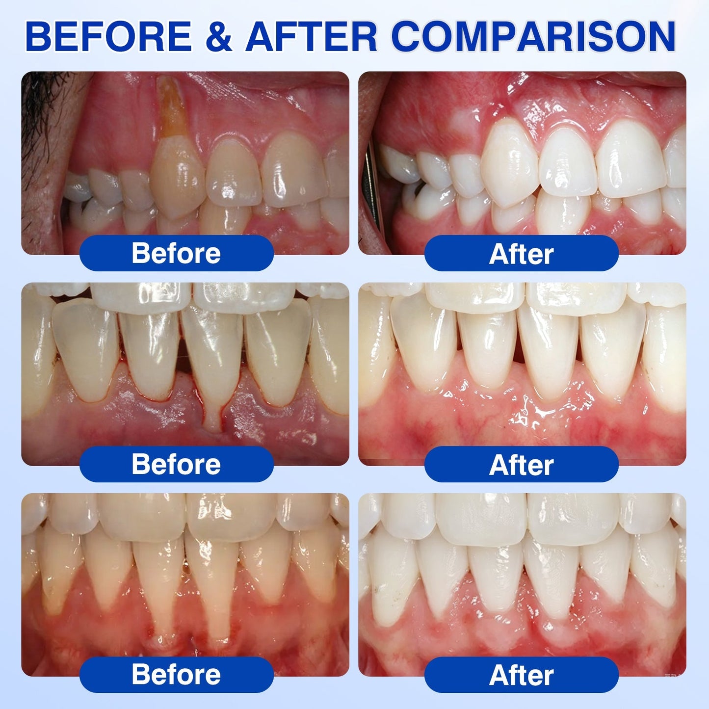 🇨🇦👨‍⚕️🦷🛡️Rosviel® GumRevive Periodontal Repair Gel
