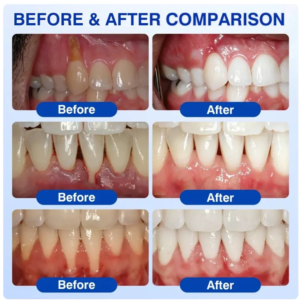 Rosviel® 🦷GumRevive Periodontal Care Gel🍀